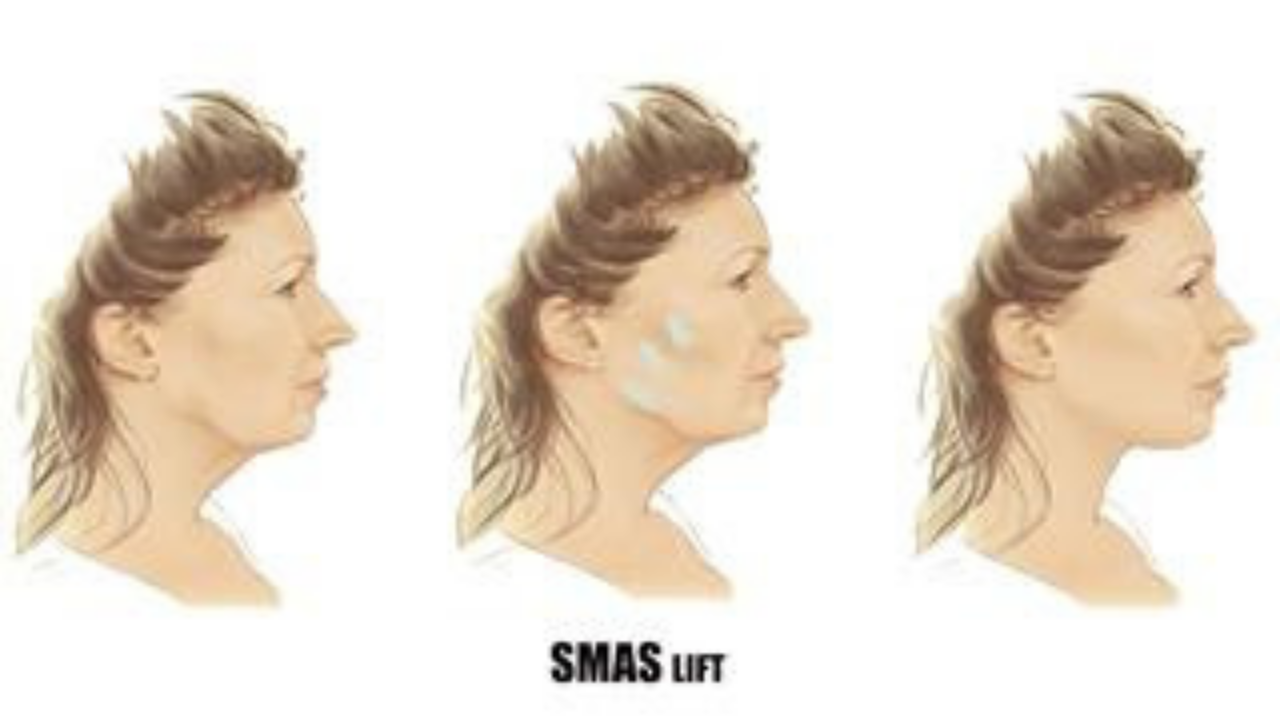 Prof. Dr. Ahmet Karacalar %22Nanoteknoloji Ve Derin Smas Lift Yüz Germeyi Şekillendiriyor%223