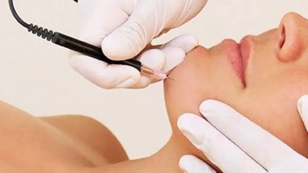 Bursa’da İğneli Epilasyonda Güvenilir İsim Esra Şanlı5