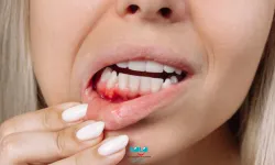C Vitamini Eksikliği Diş Eti Kanamalarına Yol Açabiliyor