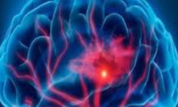 BEYİN KANAMASI NEDİR? ACİL BELİRTİLERİ VE MODERN TEDAVİ YÖNTEMLERİ