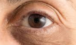 Göz Altı Morlukları Neden Oluşur, Nasıl Geçer? Uzmanlardan Kesin Çözüm Yöntemleri ve Tedavileri