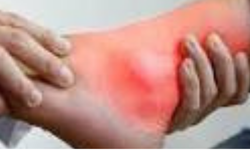 GUT HASTALIĞI NEDİR? Belirtileri, Nedenleri, Evreleri ve Güncel Tedavi Yöntemleri