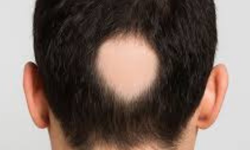 SAÇKIRAN (ALOPECİA AREATA) NEDİR? NEDEN OLUR VE NASIL TEDAVİ EDİLİR?