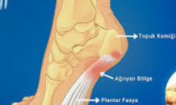 Topuk Dikeni Nedir? Neden Olur? 2026 Modern Tedavi Yöntemleri ve Egzersizler