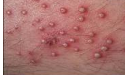 Çıban Nedir? Çıban Neden Çıkar ve  Tedavi Süreci?