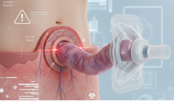 Stoma Nedir, Sarkma (Prolapsus) Neden Olur?