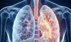 Zatürre Neden Olur, Nasıl Tedavi Edilir?