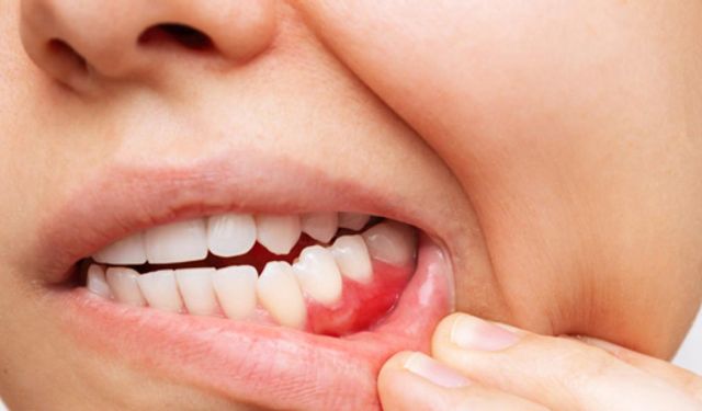 Diş Eti Şişmesi Neden Olur? Nasıl Geçer? İşte Tüm Detaylar