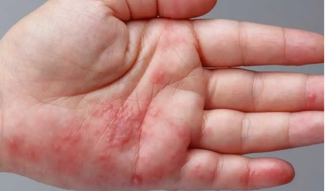 Zona (Gece Yanığı) Hastalığı Nedir? Belirtileri, Nedenleri ve Tedavisi Hakkında Kapsamlı Bilgiler