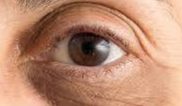 Göz Altı Morlukları Neden Oluşur, Nasıl Geçer? Uzmanlardan Kesin Çözüm Yöntemleri ve Tedavileri