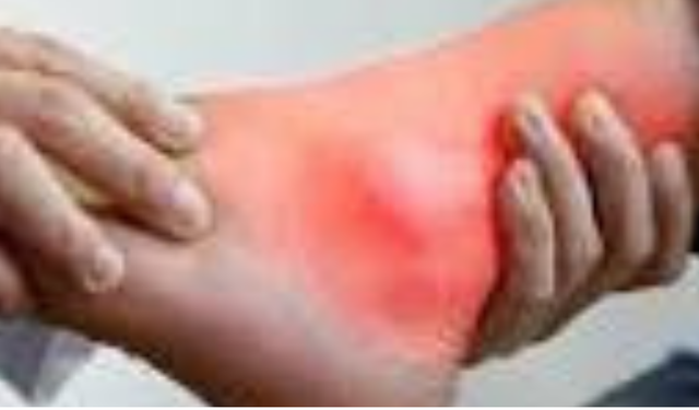 GUT HASTALIĞI NEDİR? Belirtileri, Nedenleri, Evreleri ve Güncel Tedavi Yöntemleri