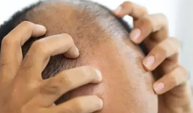 Tıpta Yeni Sayfa Açılıyor! Kelliğe Kesin Çözüm Geliyor mu?