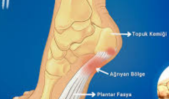 Topuk Dikeni Nedir? Neden Olur? 2026 Modern Tedavi Yöntemleri ve Egzersizler