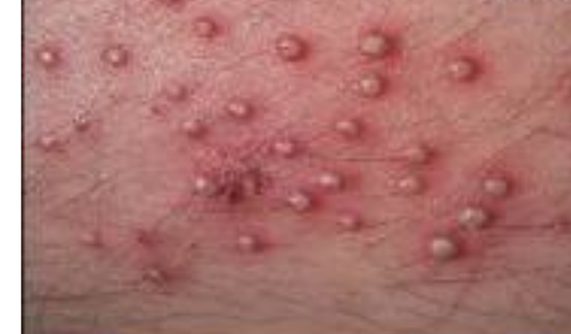 Çıban Nedir? Çıban Neden Çıkar ve  Tedavi Süreci?