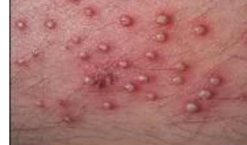 Çıban Nedir? Çıban Neden Çıkar ve  Tedavi Süreci?